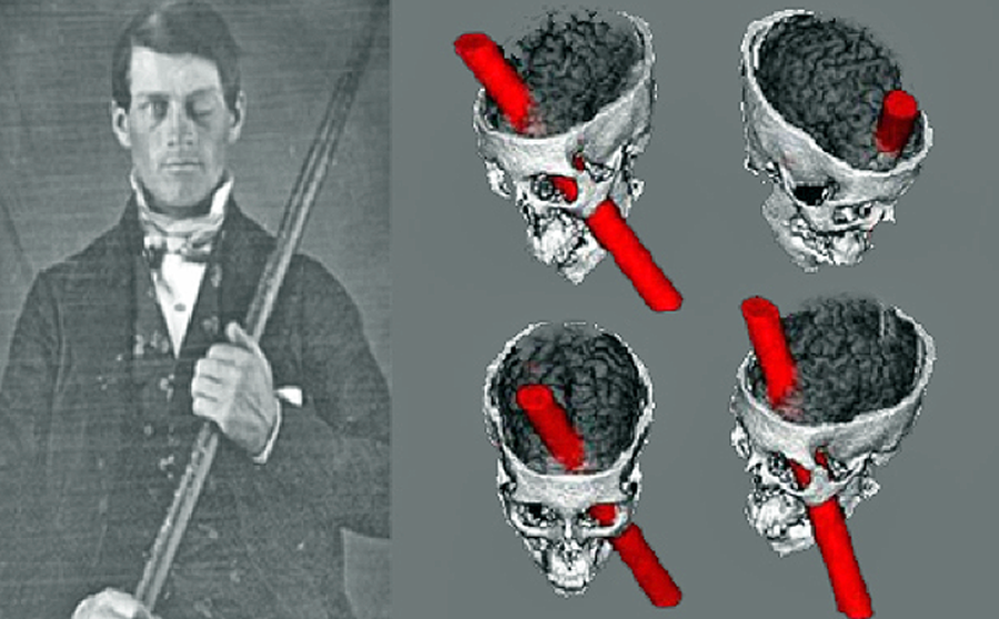 La storia di Phineas Gage: l’uomo che cambiò le neuroscienze