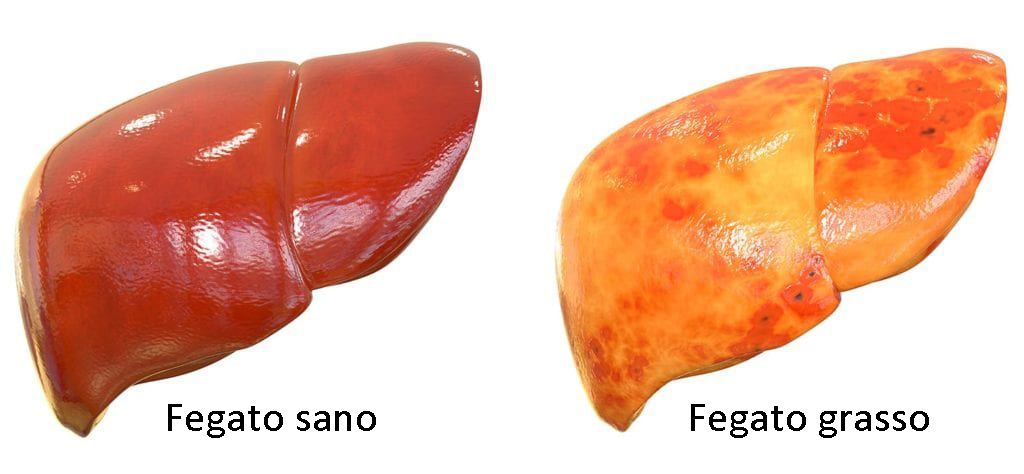 Non c'è il fegato curvy, ma l’anticamera della cirrosi epatica