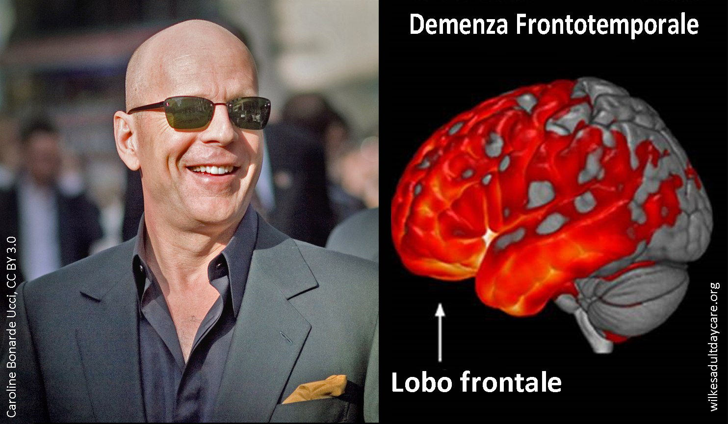 Bruce Willis affetto da Demenza Frontotemporale, quali implicazioni con alimentazione e attività fisica?